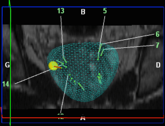 Biopsies de prostate avec fusion d’images IRM-échographie (système Koelis)