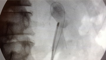 Ureteroscopie