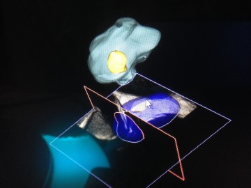 Focal One HIFU 004