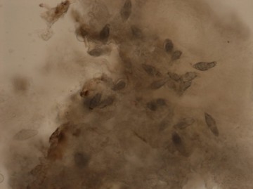 Oeuf de schistosomias haematobium reconaissables à leur épine caractéristique