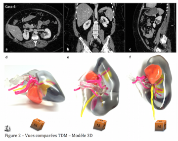 rein_tumeur_néphrectomie_partielle_robotique_impression_3D_scanner_partial_nephrectomy