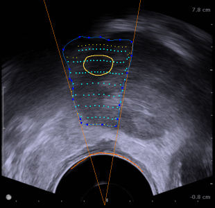 focal_therapy_prostate_cancer
