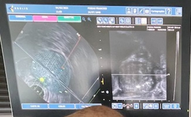Écran de fusion d’images lors de biopsies de prostate